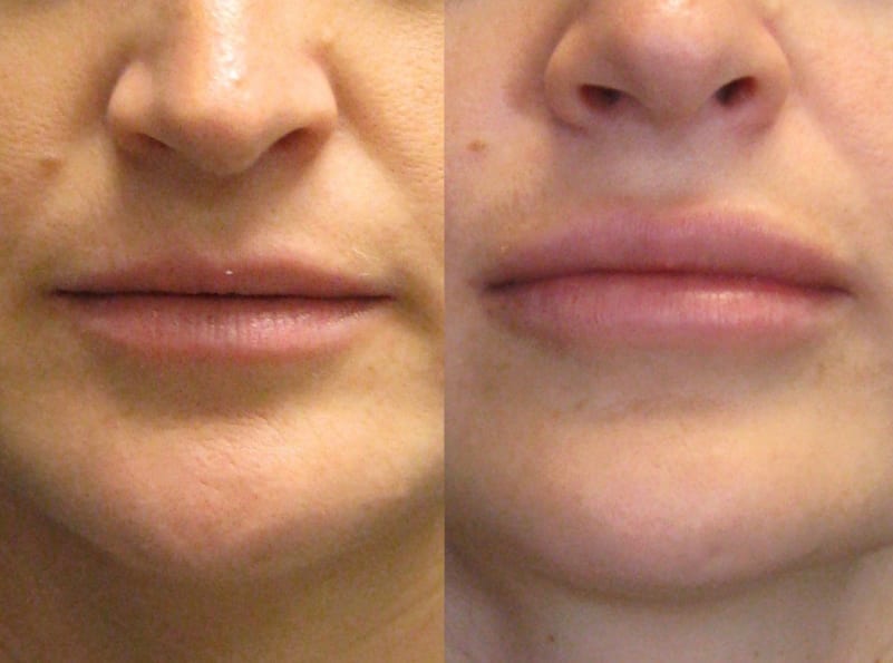 Lip Enhancement Patient 01 facing forward, showing difference in lips. lip-enhancement-before-after-patient-1a