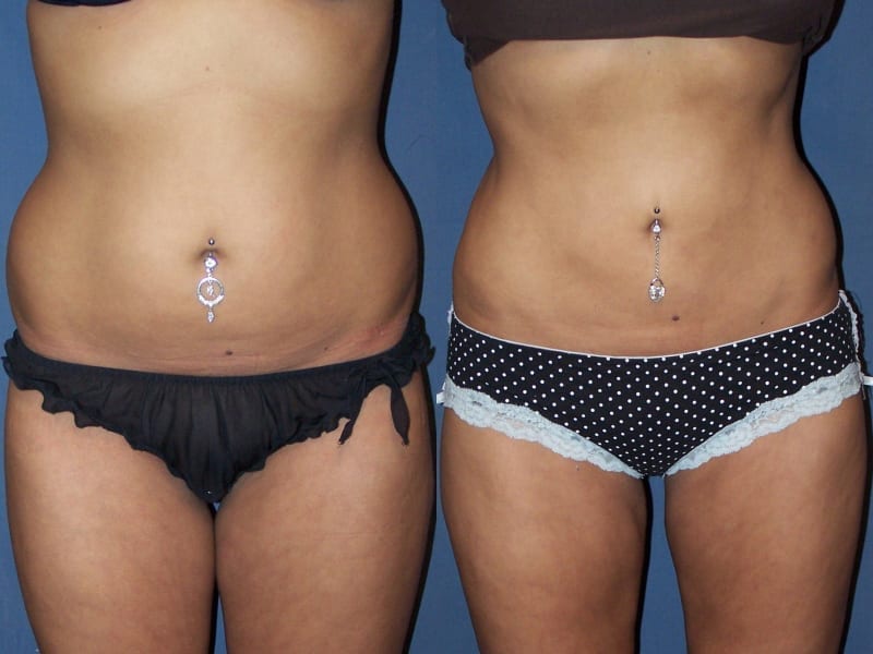 Liposuction Patient 07 before and after facing forward, showing reduced fat on abdomen and waist. liposuction-before-after-patient-7a
