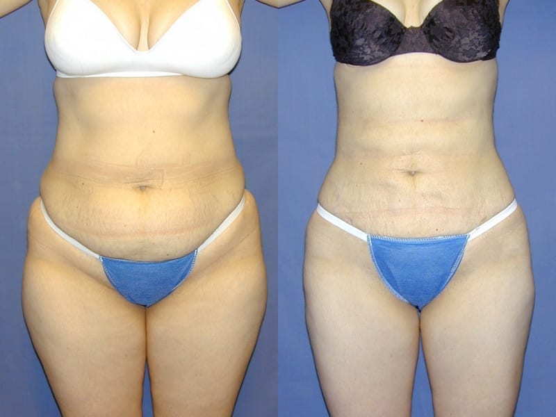 Liposuction Before & After Gallery: Patient 16
