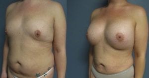 Before and After Image