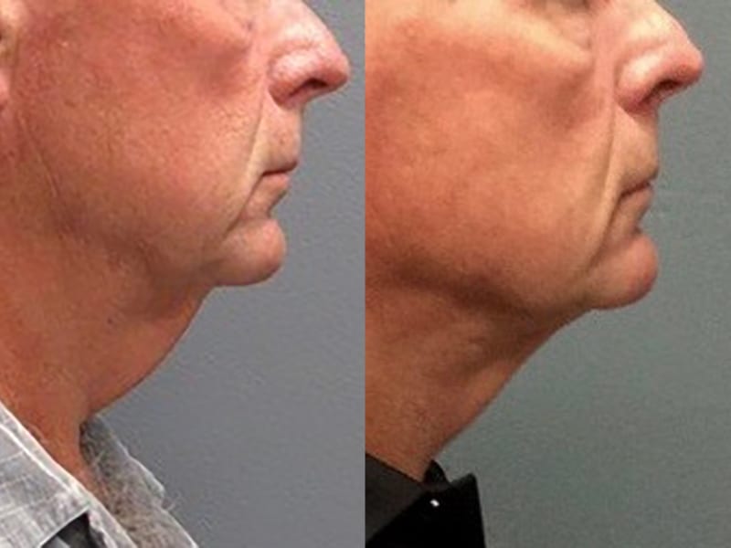 Neck-Lift Patient 01 before and after, facing right, showing reduction in neck. neck-lift-before-after-patient-1a