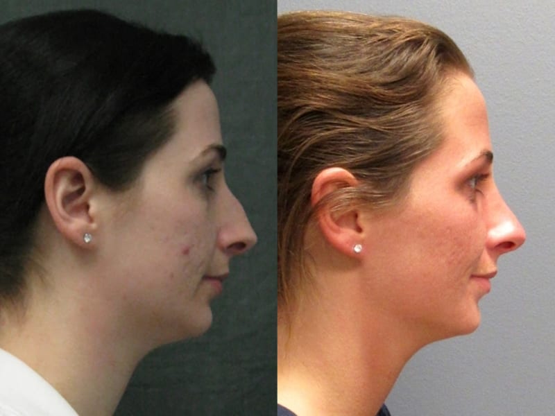 Rhinoplasty Patient 02 before and after facing right, showing change in nose. rhinoplasty-before-after-patient-2d