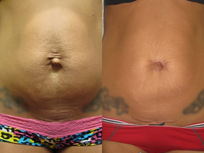 Umbilicoplasty Patient 01 before and after facing forward, showing marked difference on belly button. umbilicoplasty-before-after-patient-1a