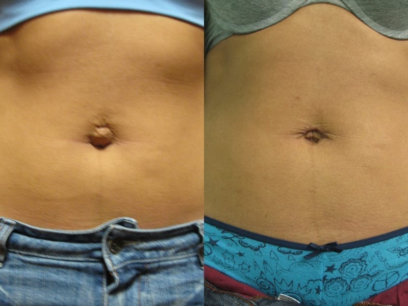 Before and After Image